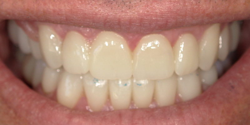 Image for Full Mouth Rehabilitation with Crowns and Partial Dentures