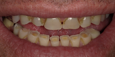 Image for Full Mouth Rehabilitation with Crowns and Partial Dentures