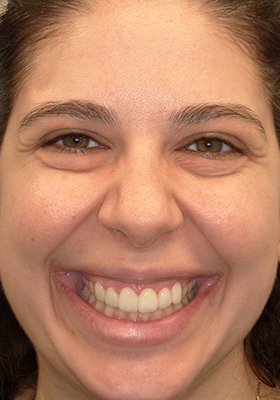 smile-veneer-after-full-01