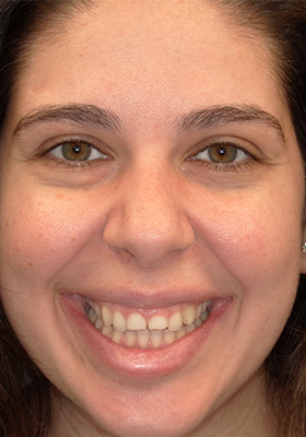 smile-veneer-before-full-01-2