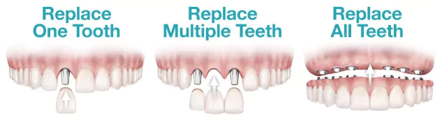 dental-implants-for-missing-teeth