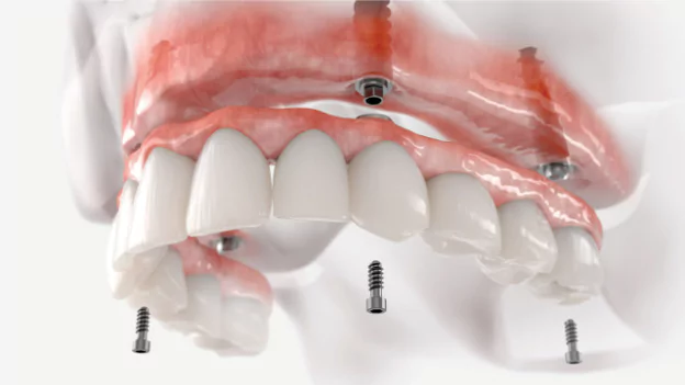 faqs-about-dental-implants