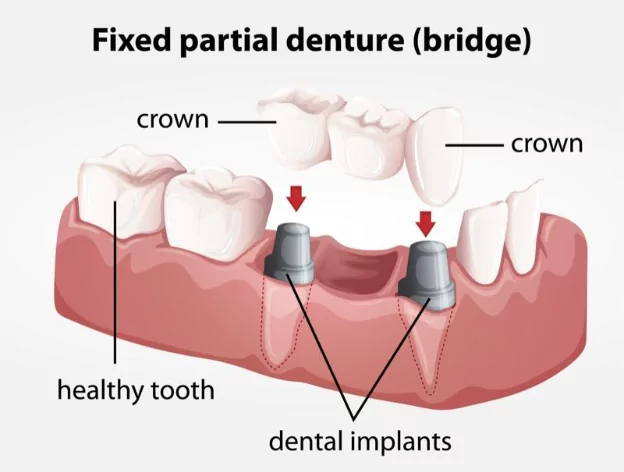 smile-with-dental-crowns