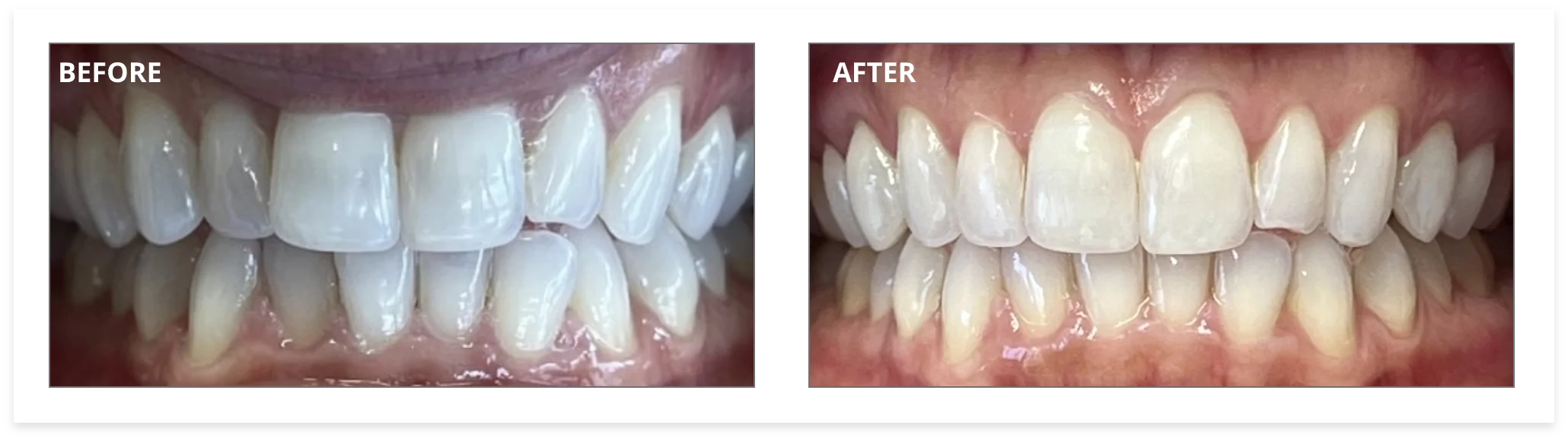 invisalign-before-01