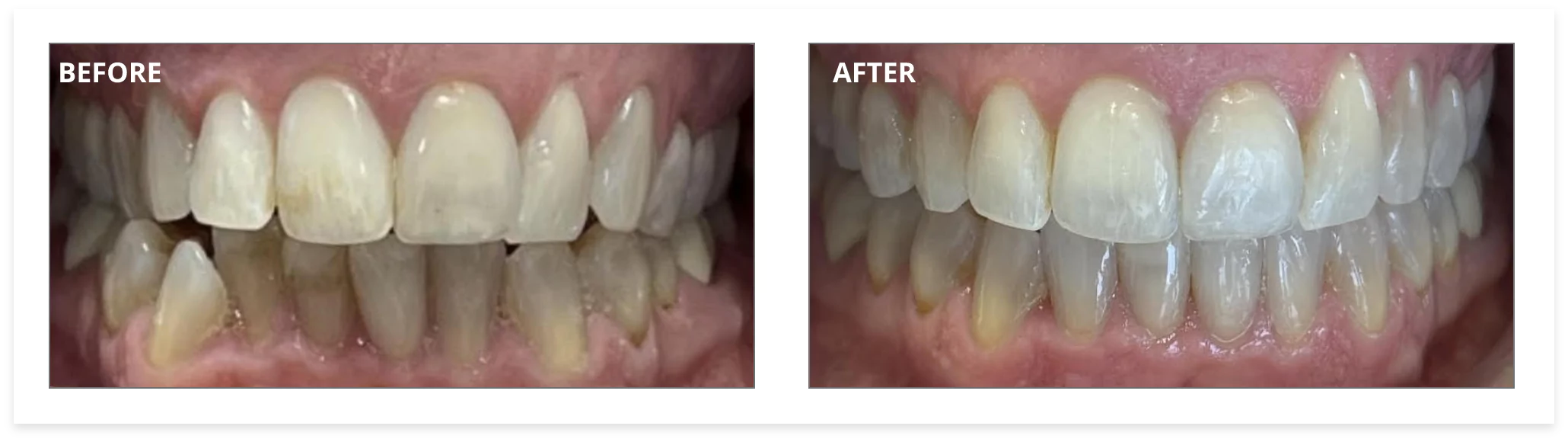 invisalign-before-after-02