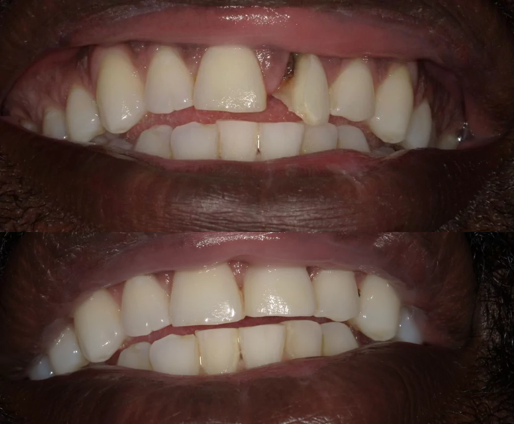 implant-before-after-01