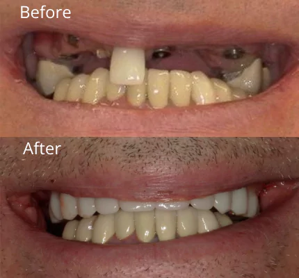 implant-before-after-02