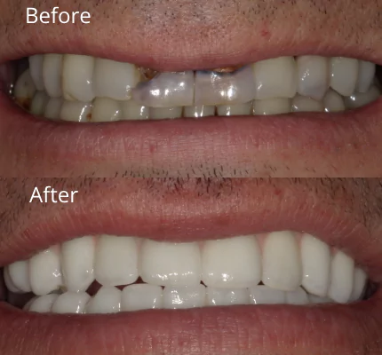 implant-before-after-03